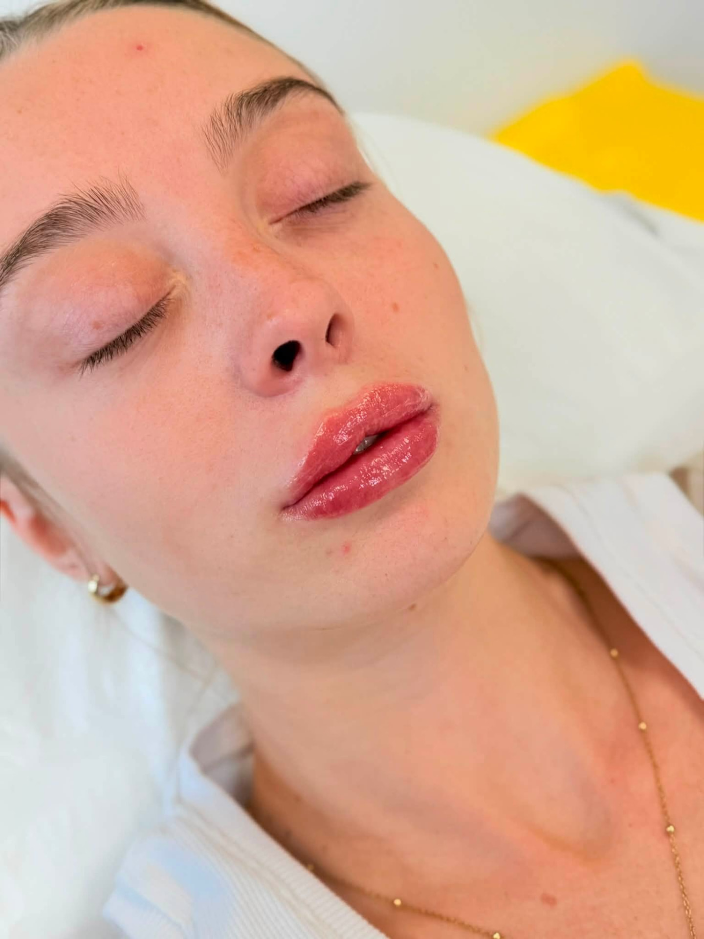 Genuine Simply Skin lip treatment result